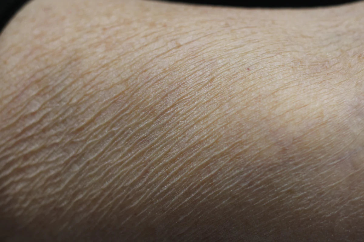 Senté Dermal Repair Body Cream Before