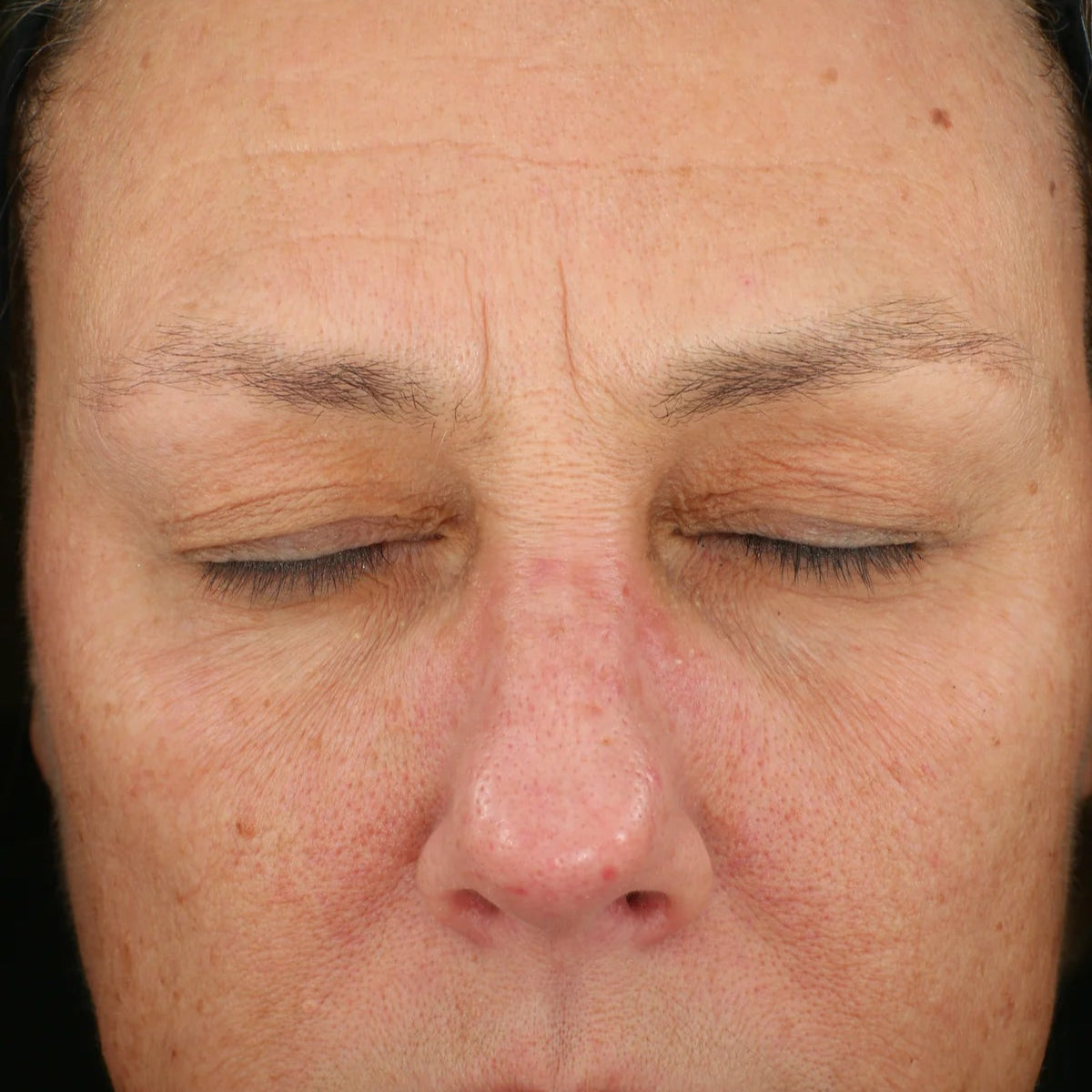 Senté Dermal Repair Cream Before
