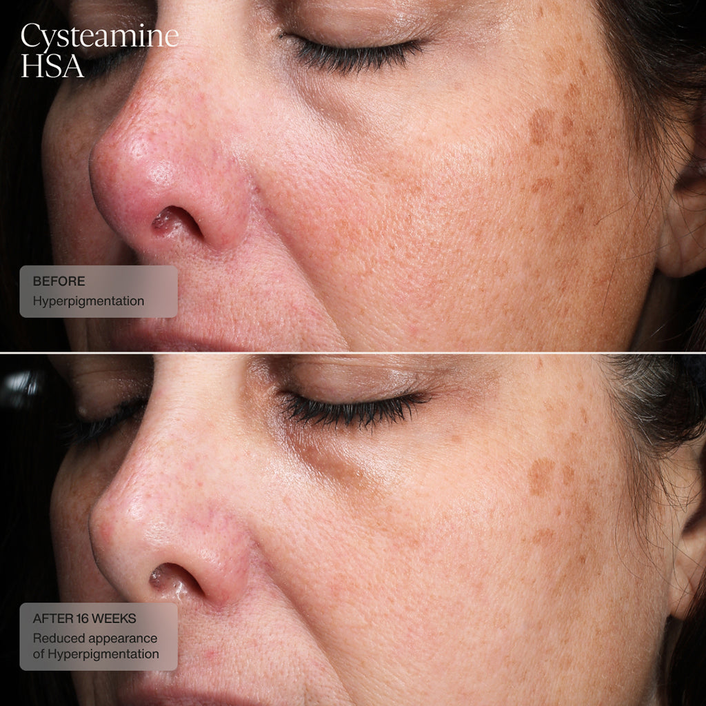 Senté Cysteamine HSA Before and After