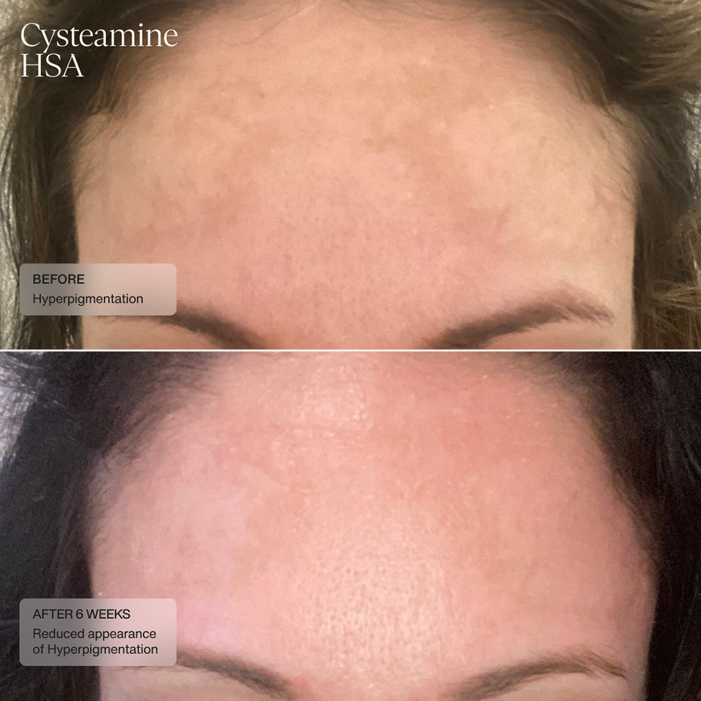 before and after 6 weeks showing improved skin tone and texture