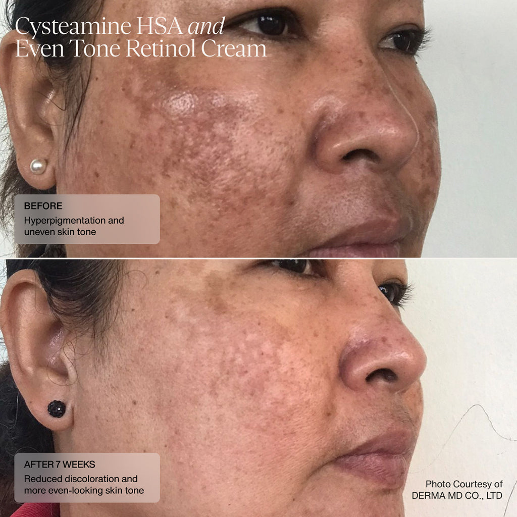 Senté Cysteamine HSA and Even Tone Retinol Cream Before and After