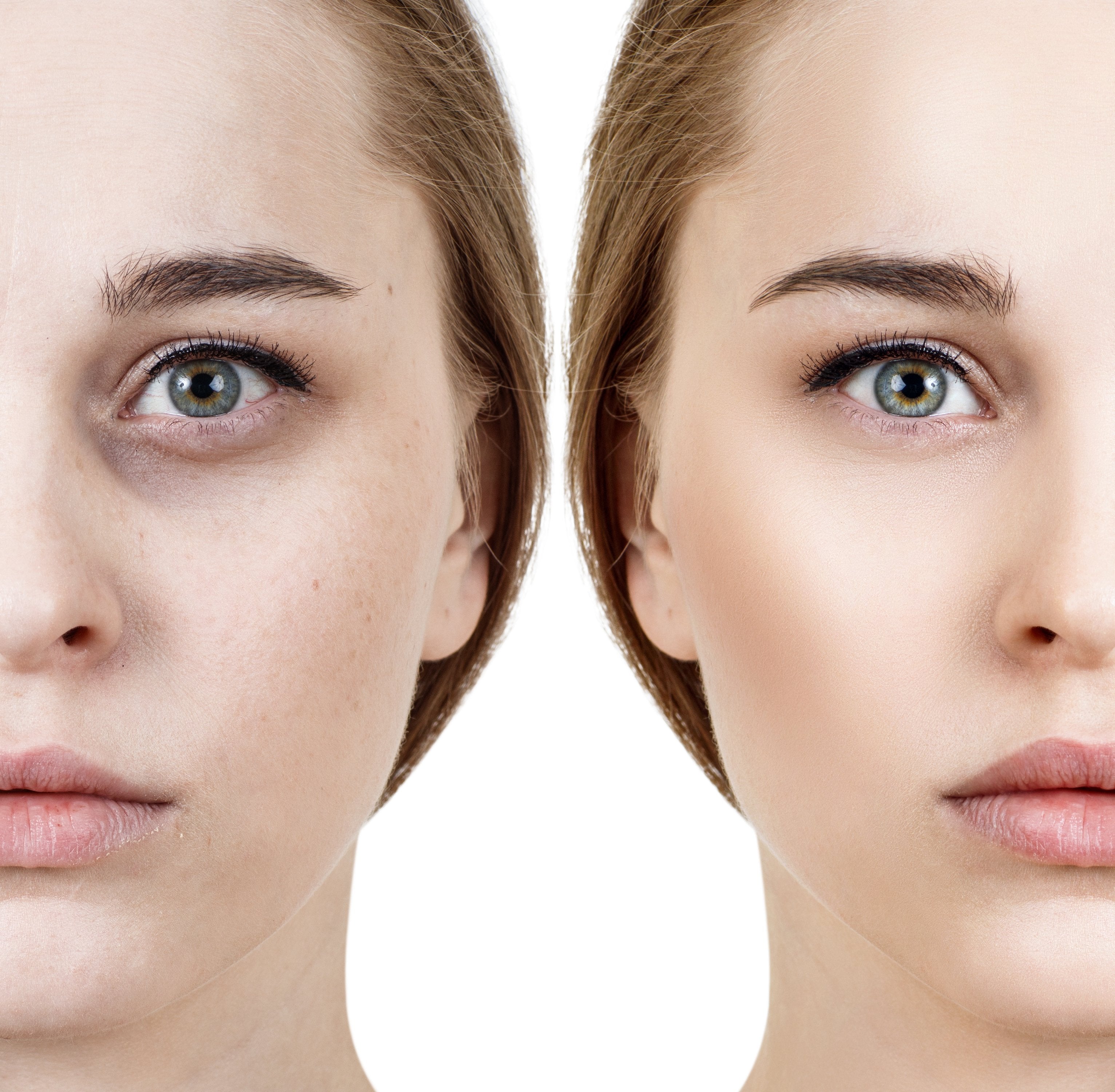Eye bags and Dark Circles