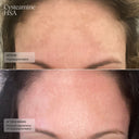 before and after 6 weeks showing improved skin tone and texture