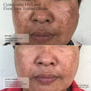 before and after 7 weeks showing improved hyperpigmentation and texture