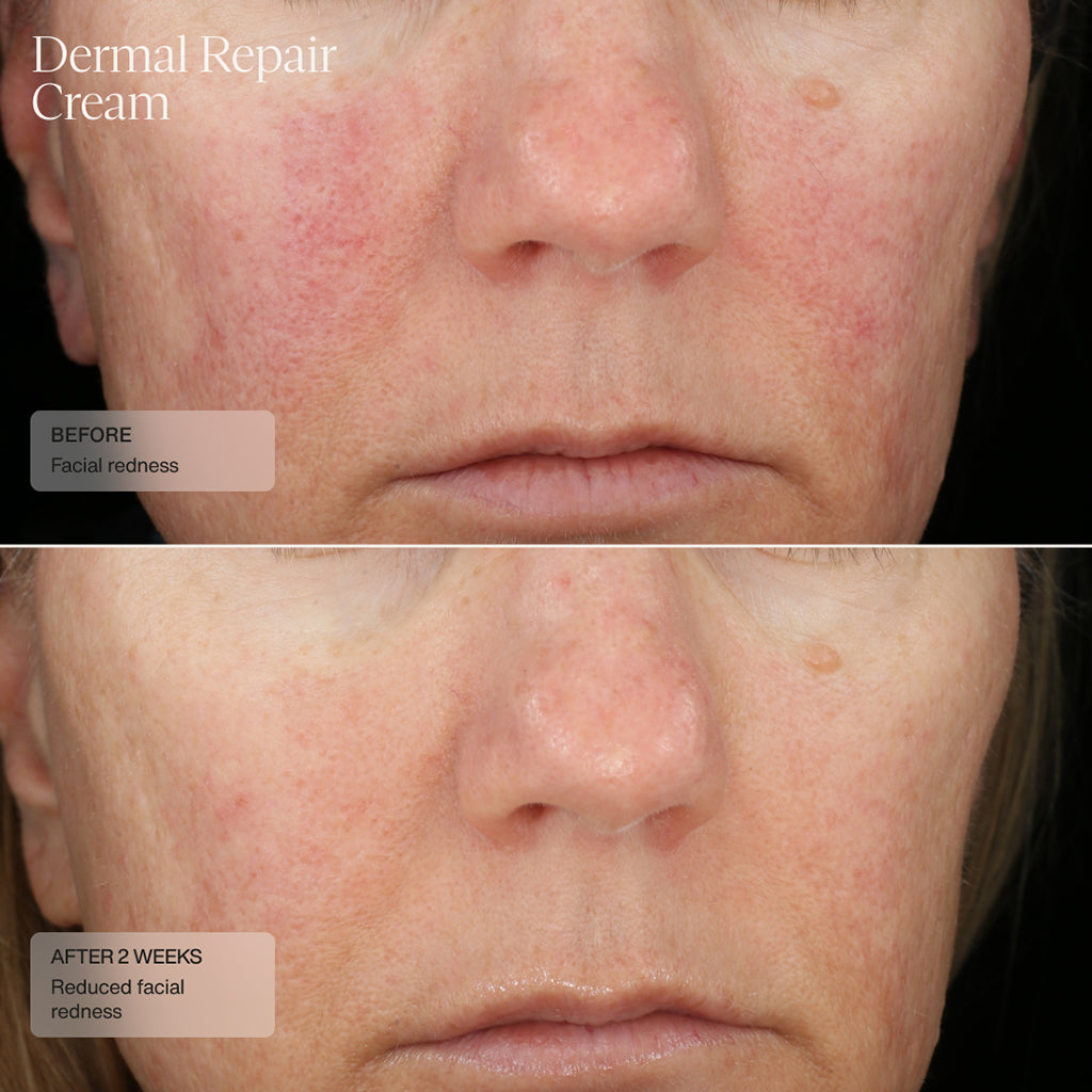 before and after 6 weeks showing improved facial redness