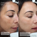 before and after using HSA creme treating hyperpigmentation