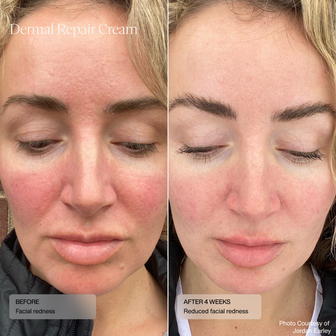 before and after showing reduced facial redness