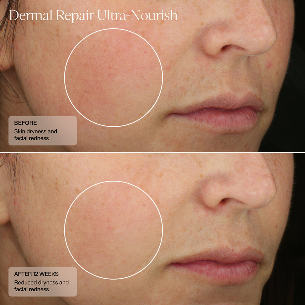 before and after 6 weeks showing improved dryness and facial redness